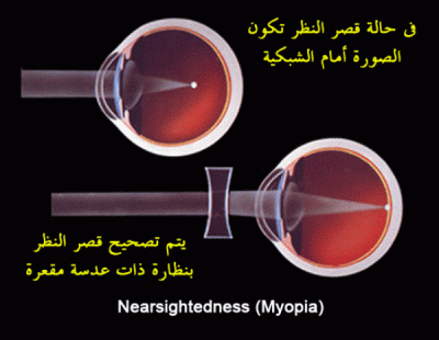 قصر النظر الحاد والتقدم في السن.. عوامل تشجع ...